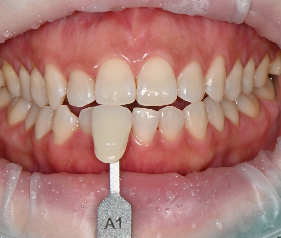 Tone Up Your Teeth in Just One Day! A Whitening Treatment Review at Seoul Of Dental image 3