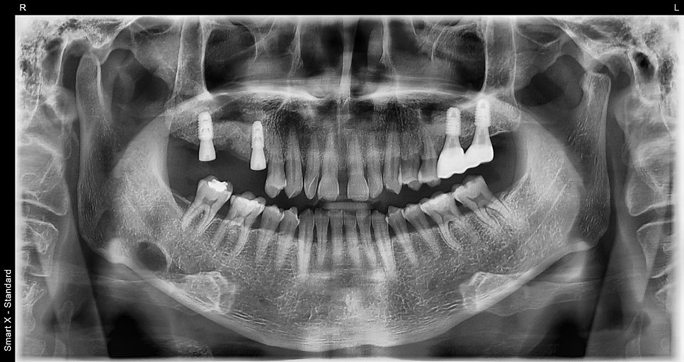Don’t wait after extraction—place it right away! The golden time when bone comes back to life image 4