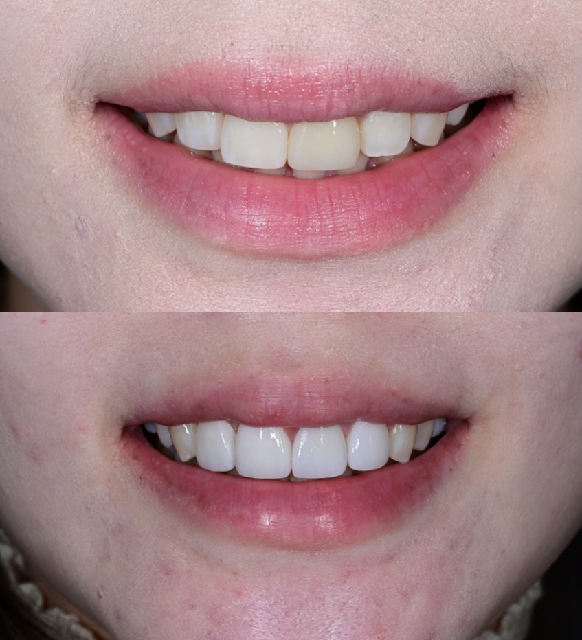 Rabbit Teeth Veneers: Treatment to Achieve Natural Front-Tooth Proportions image 8