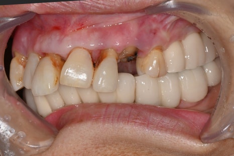 앞니 임플란트, 전치부 심미까지 살린 치료 과정 정리 관련 이미지 6