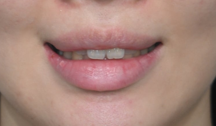 Jamsil Veneers: Worried About Rabbit Teeth? image 5