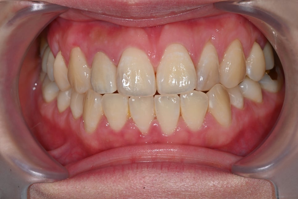How We Naturally Improved an Upper Front Tooth Crown Retreatment, Including Color Differences and the Gum Line image 14