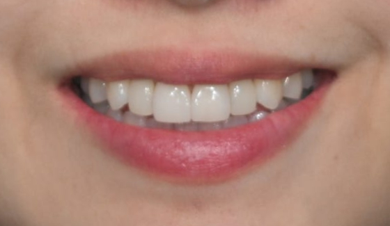 Laminate Veneers for Protruding Teeth: If They’re Too Thick, They Look Even More Prominent image 5