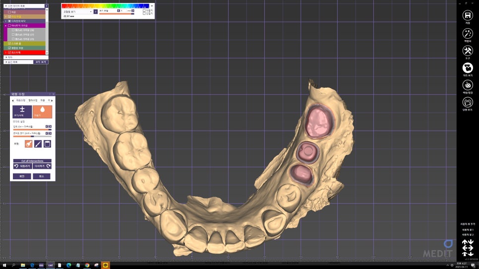 Front Tooth Crown + Implant for an Overseas Patient: What Made It Possible to Finish in 4 Months? image 5
