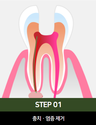The Power to Protect Natural Teeth: Seoul Orbe Dental Hospital’s Philosophy of Conservative Treatment image 11