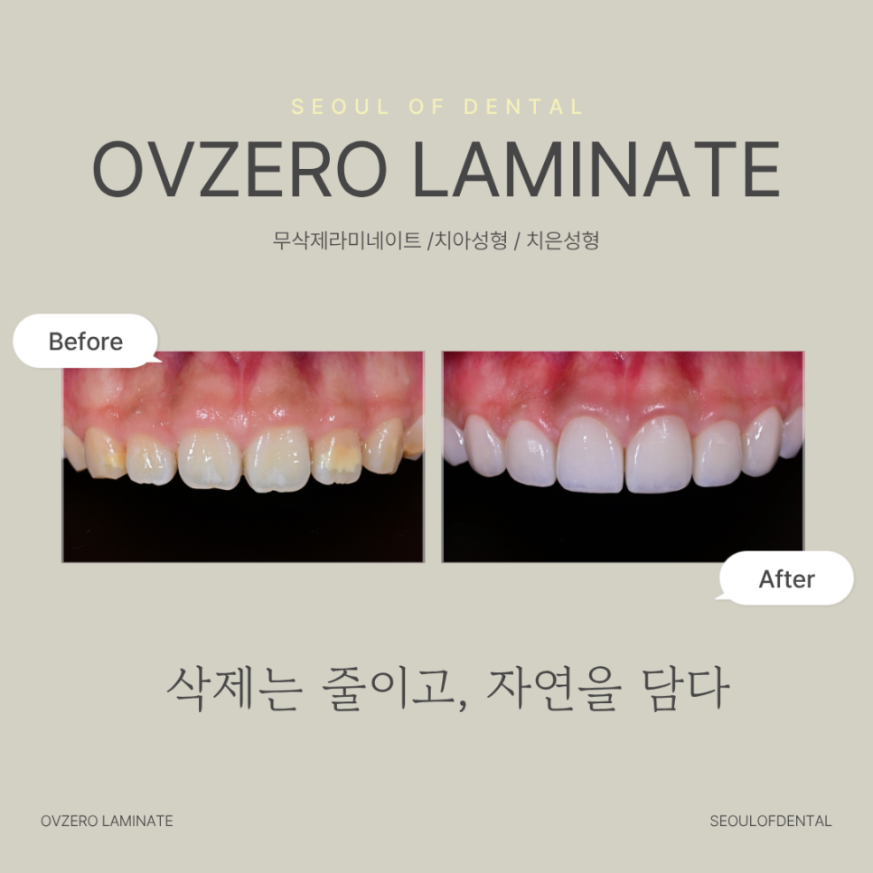 Samjeon Station Dental Clinic: A Case of Improving Discolored Teeth with No-Prep Ove Zero Laminates image 1