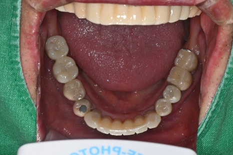 Immediate Implant Placement After Extraction! Seoulove Dental’s Fast Full-Mouth Implant Treatment Completed in 4 Months image 8