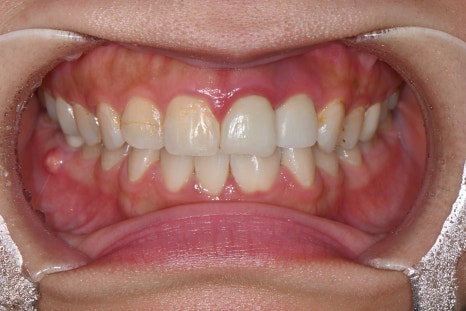 Possible Front Tooth Prosthetic Replacement Even While Staying Abroad! A Natural Smile Completed on a Short Schedule✨ image 2