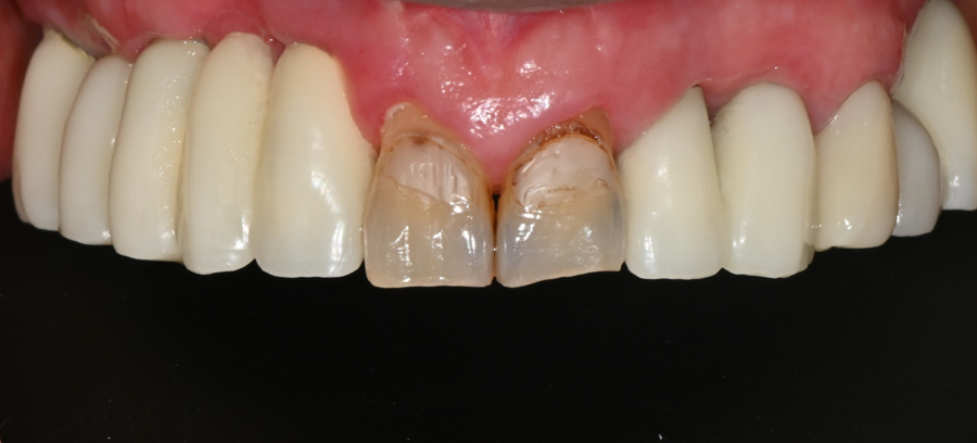 Front Tooth Laminate Veneers Are Natural Even at 70 — A Senior OVZERO Treatment Case image 2