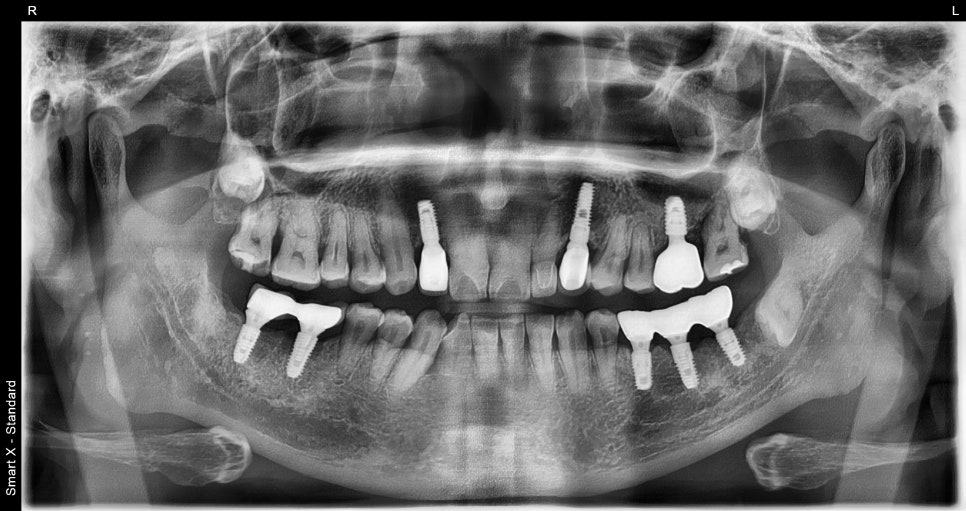 어금니 임플란트가격, 임플란트치과에서 진행한 실제 치료 과정 관련 이미지 13
