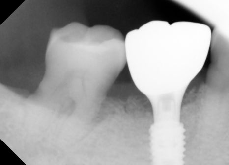 Understanding Implant Price Differences Through the Molar Implant Process image 14