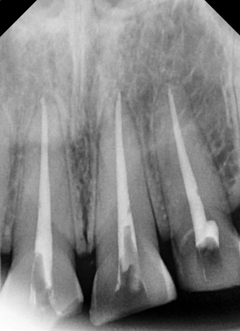 Songpa Dental Clinic, a Case of Crown Restoration After Root Canal Treatment for a Woman in Her 20s With a Broken Front Tooth image 10
