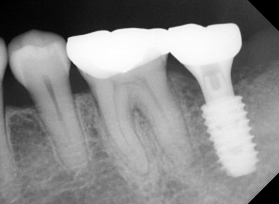 Sammyeon Station Dental Clinic Molars Implant Price, Treatment Process from Extraction to Prosthetics image 11