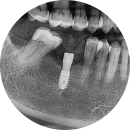 Songpa-gu Implant: Surgical Case of a Foreign Woman in Her 50s (feat. Foreigners’ Dental Clinic) image 5
