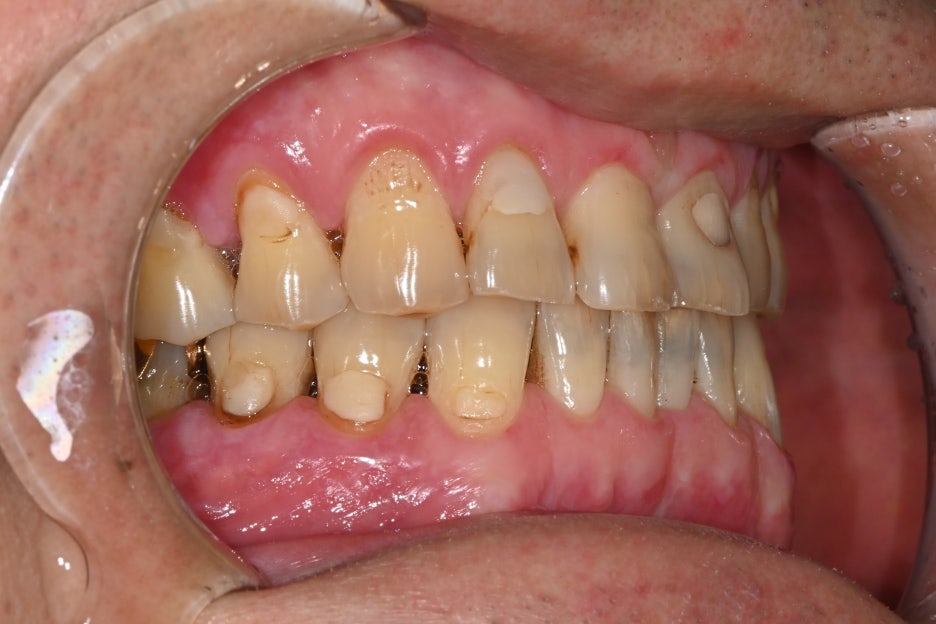 Jamsil Dental Hospital Implant Price and Treatment Case image 3