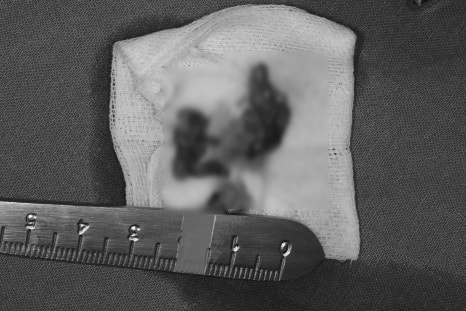 About Jawbone Benign Tumors and IV Sedation at Samjeon Station Dental Clinic image 3