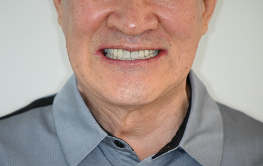 Front Tooth Laminate Veneers Are Natural Even at 70 — A Senior OVZERO Treatment Case image 9