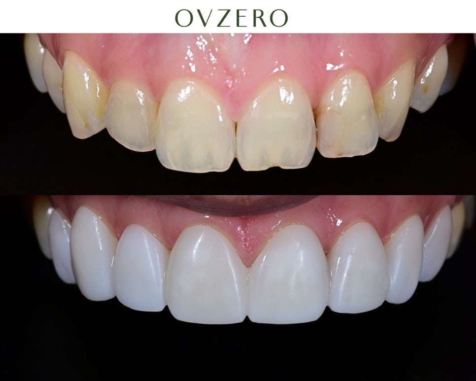 Introducing the OVZERO 2.0 Lineup | Criteria for Choosing the Right No-Prep Laminate | No-Prep Laminate Cost image 4