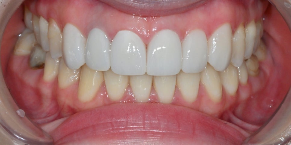 Discolored Front Teeth: Are Crowns the Only Answer? image 7