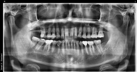 Things You Must Check Before Implant Treatment image 6