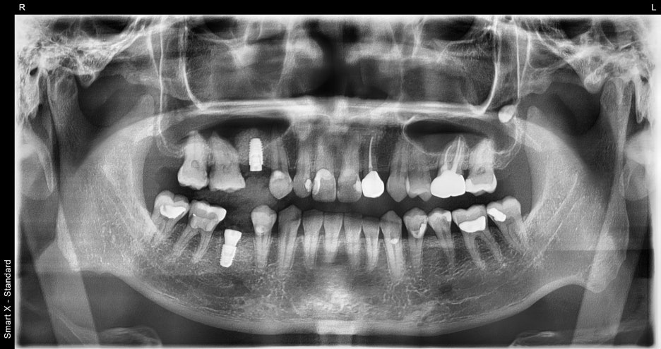 Songpa Dental Clinic: Implant After Molar Extraction image 14