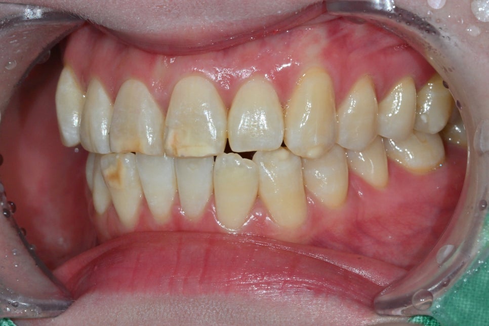 Songpa Dental Clinic: A Case of Improving Mottled Teeth with Veneers image 5