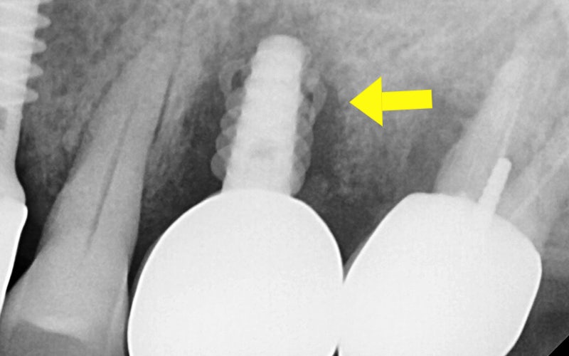 Samjeon Station Implant: Why do some break while others can last a lifetime? image 4