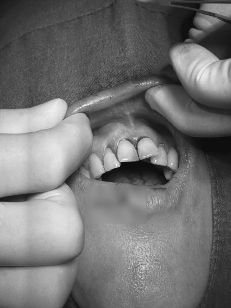 Treatment Process Revealed for a Fall That Injured Both the Front Teeth and Lip image 9