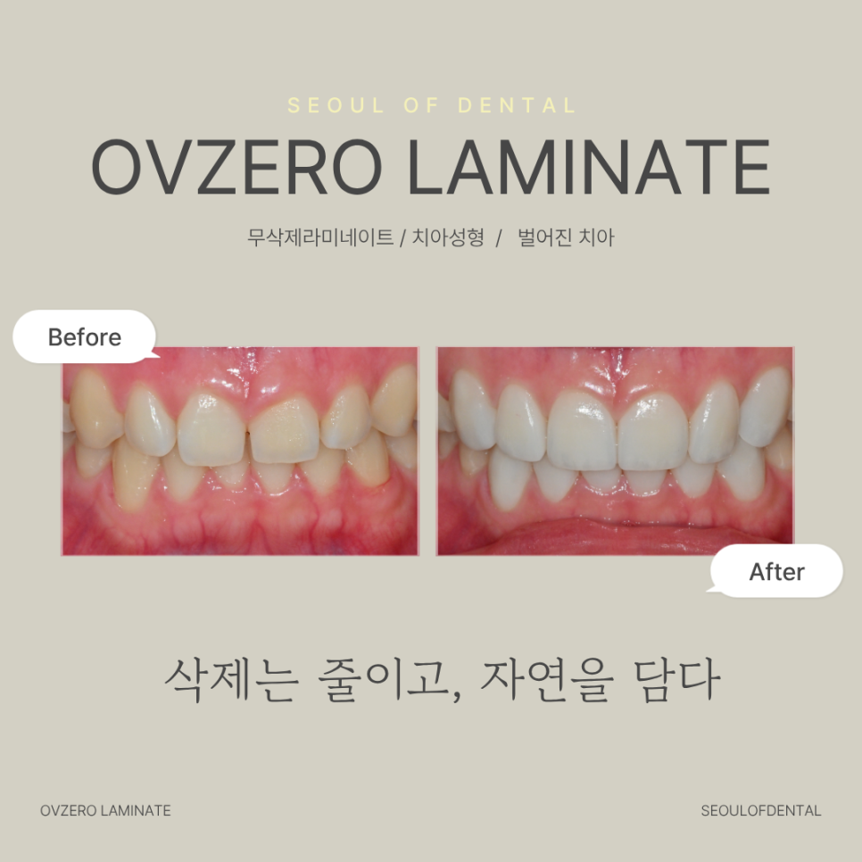 오브제로 라미네이트, 어떤 치료인가요? 관련 이미지 1