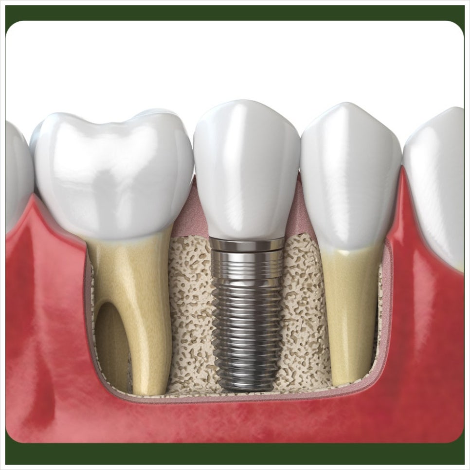 What Should You Do If You Notice Odor After an Implant? image 2