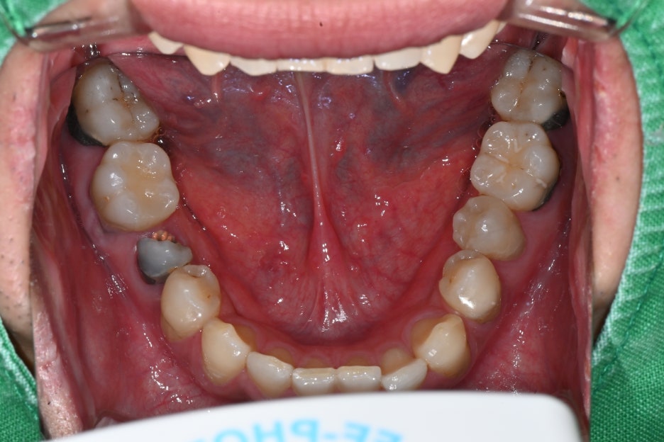 Songpa Dental Clinic: Implant After Molar Extraction image 11