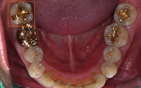 Songpa-gu Dental Clinic: Solving a Case Where Prosthetics Were Impossible with Implant Reoperation! image 3