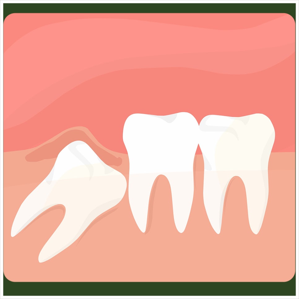 Bad Breath After Wisdom Tooth Extraction: What If It Got Worse After the Extraction? image 4