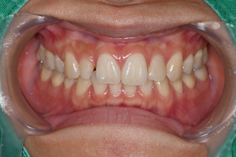 What If a Resin Filling Fell Out in the Past? Be Sure to Read This Before Retreatment! image 1