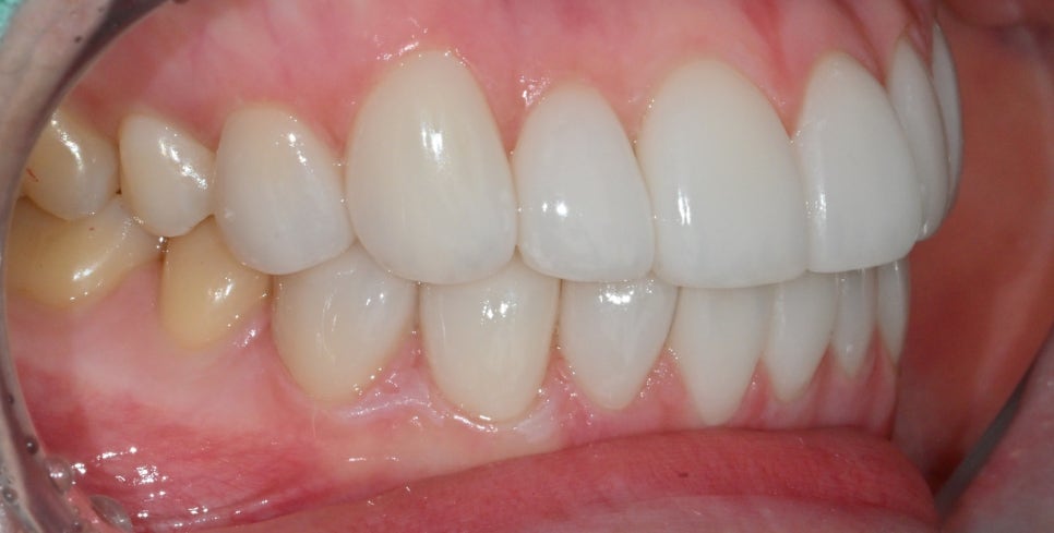 Canine Veneers Without Orthodontic Treatment image 11