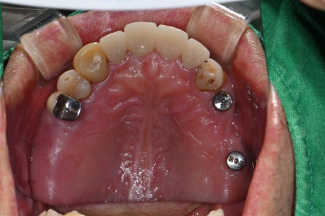 A Broken Front Tooth from a Fall, Restored Along with the Gums! Emergency Treatment Report from Seoul Ob Dental Hospital image 8