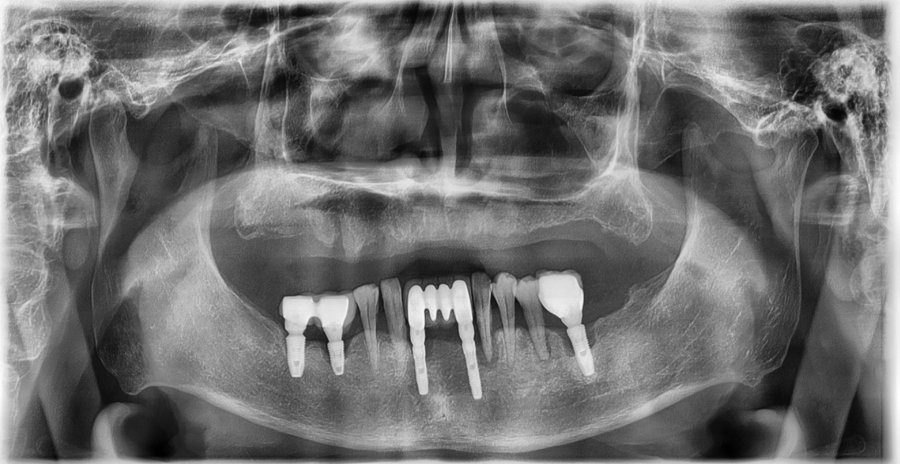 A Case Where Eating Discomfort Was Resolved with a Full Denture image 10