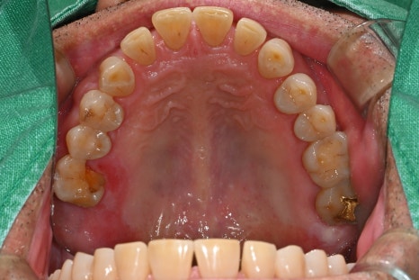 Things You Must Check Before Implant Treatment image 7