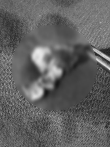 Cysts, If Left Untreated, Can Even Dissolve Bone. Introduction to an Accurate Diagnosis and Surgical Case image 5