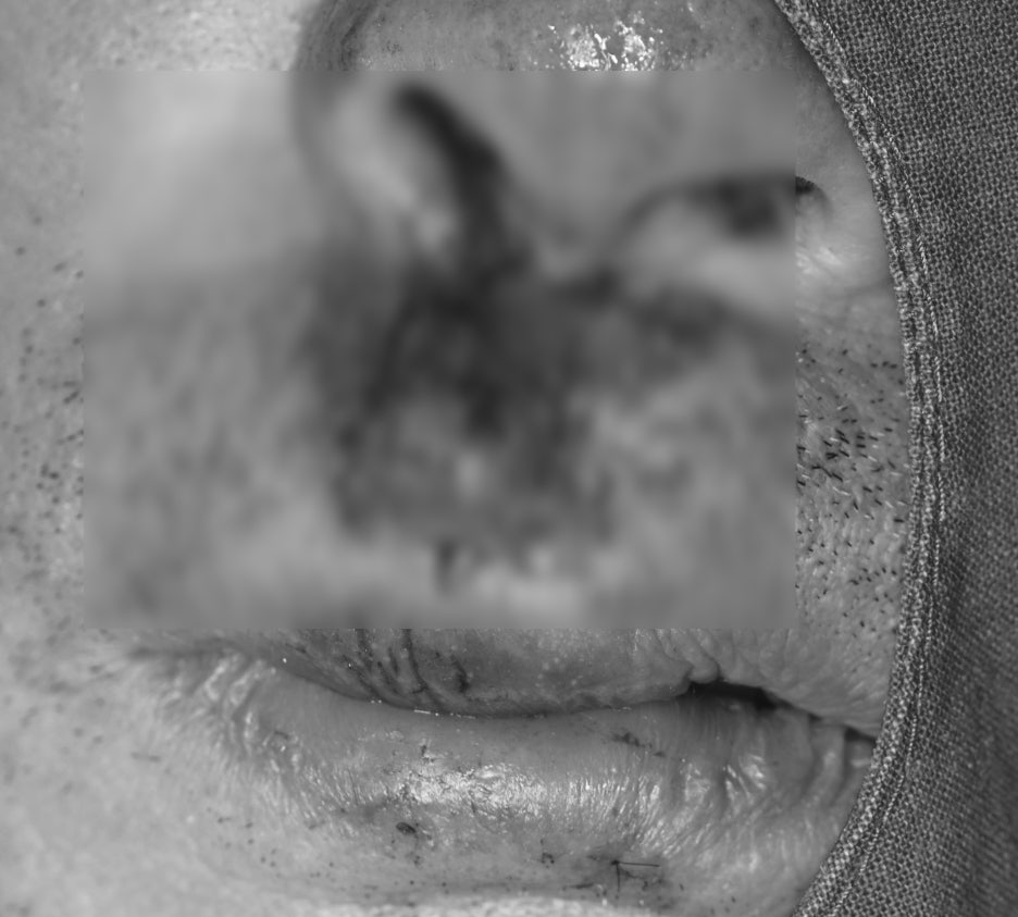 Songpa Dental Clinic: Man in His 70s Fell on Sidewalk Blocks, Requiring Laceration Suturing and Implant Surgery image 6