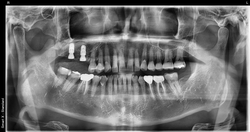 Things You Must Check Before Implant Treatment image 17