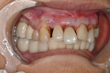 앞니 임플란트, 전치부 심미까지 살린 치료 과정 정리 관련 이미지 4