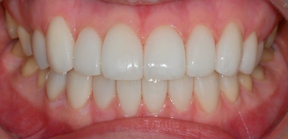 Canine Veneers Without Orthodontic Treatment image 9