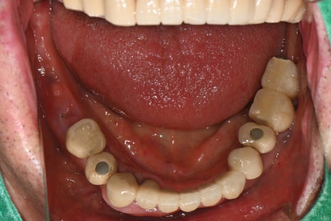 Immediate Implant Placement After Extraction! Seoulove Dental’s Fast Full-Mouth Implant Treatment Completed in 4 Months image 4