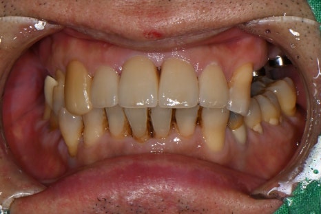 A Broken Front Tooth from a Fall, Restored Along with the Gums! Emergency Treatment Report from Seoul Ob Dental Hospital image 5