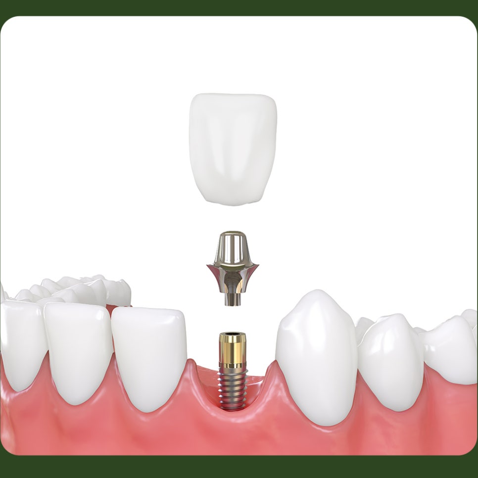 When Is Bone Grafting Needed for Implants? image 5