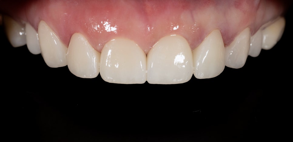 Treatment with Objetto Laminate Veneers After a Chipped Front Tooth image 11