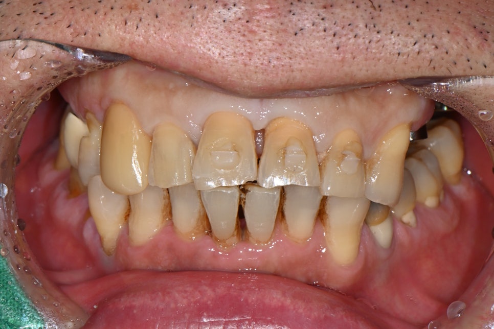 A Broken Front Tooth from a Fall, Restored Along with the Gums! Emergency Treatment Report from Seoul Ob Dental Hospital image 4