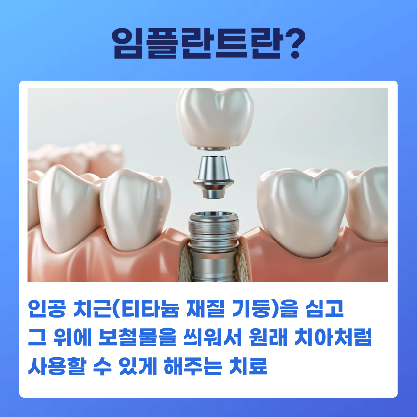 Implants, Everything You Need to Know: Q&A image 2