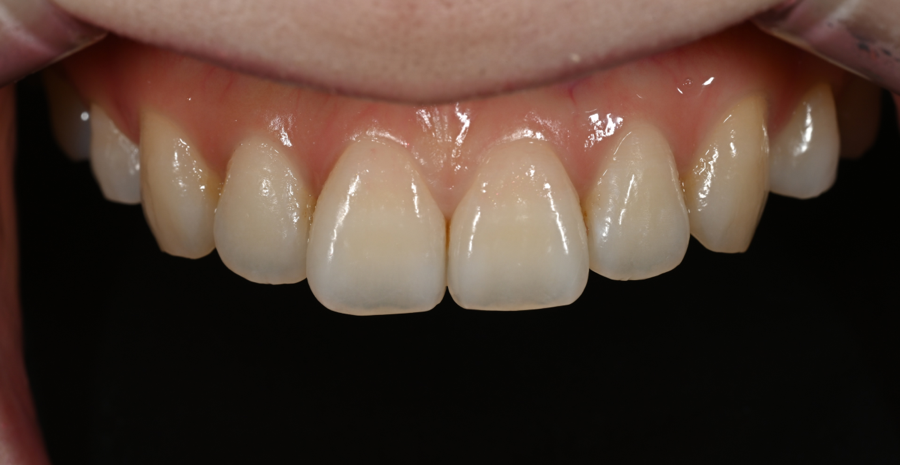 Jamsil no-prep laminate veneers: a real case of changing the impression without filing down the teeth image 2